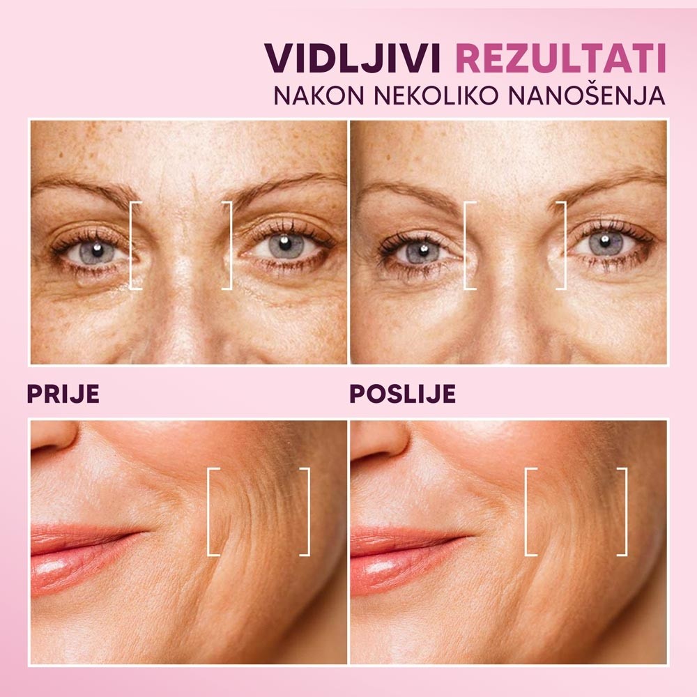 BOTOX---PRIJE-POSLIJE--bih_2